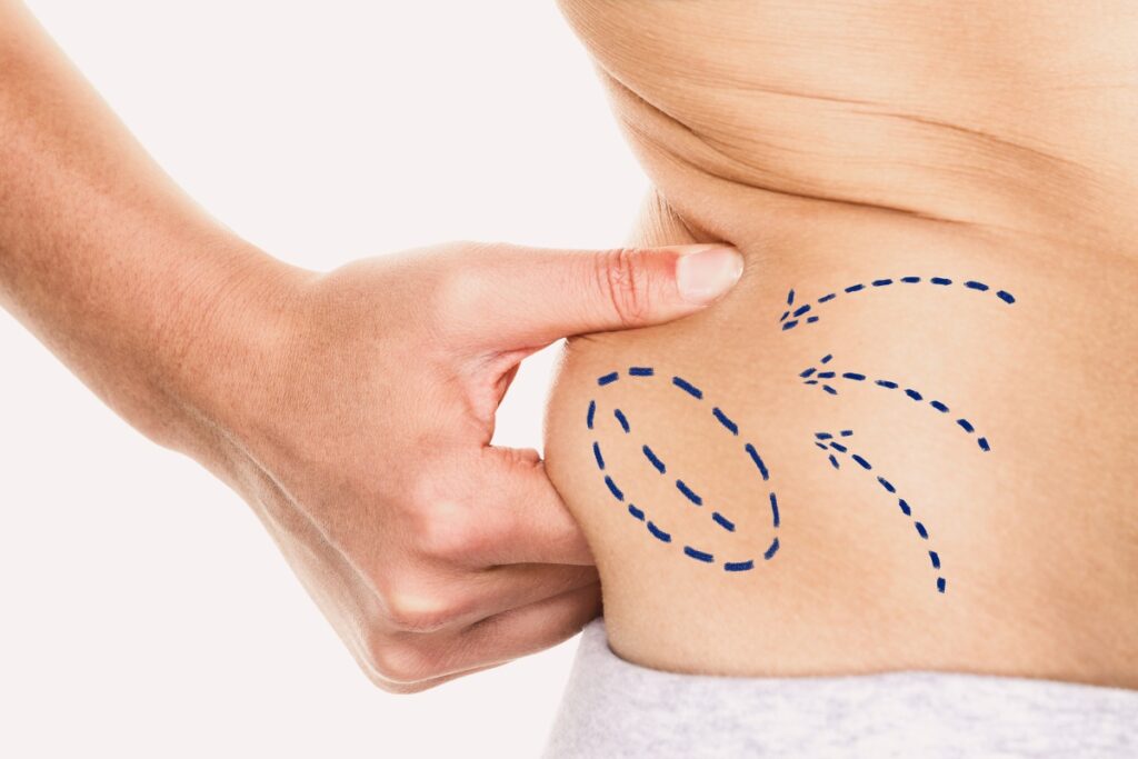 Types of Effective Liposuction