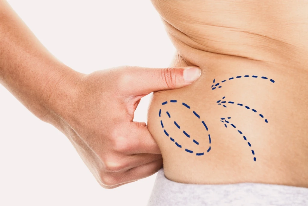 Types of Effective Liposuction