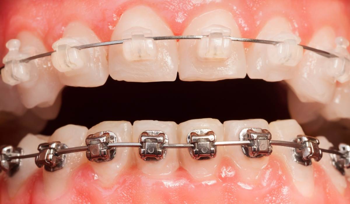 Types of Power Chains For Braces