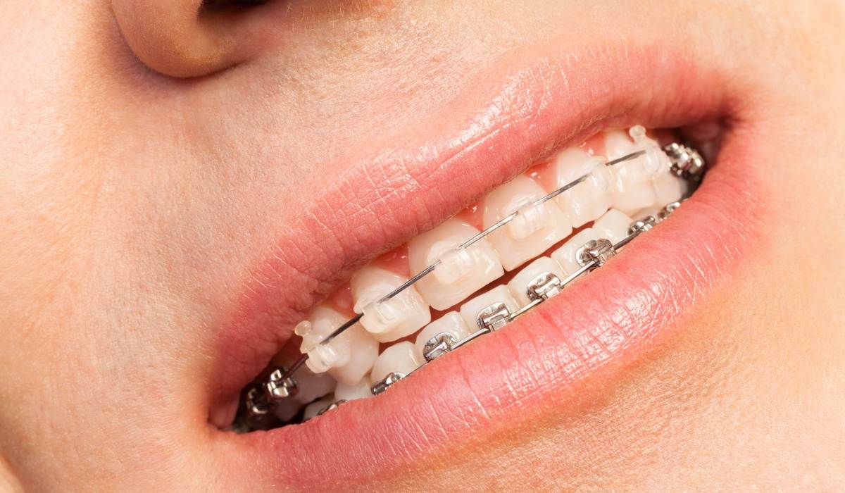 Types of Power Chains For Braces